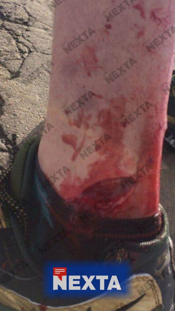 Ranny uczestnik protestów, rozerwana skórka na na kostce